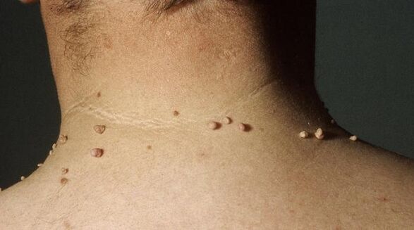 filamentous papilloma in the neck