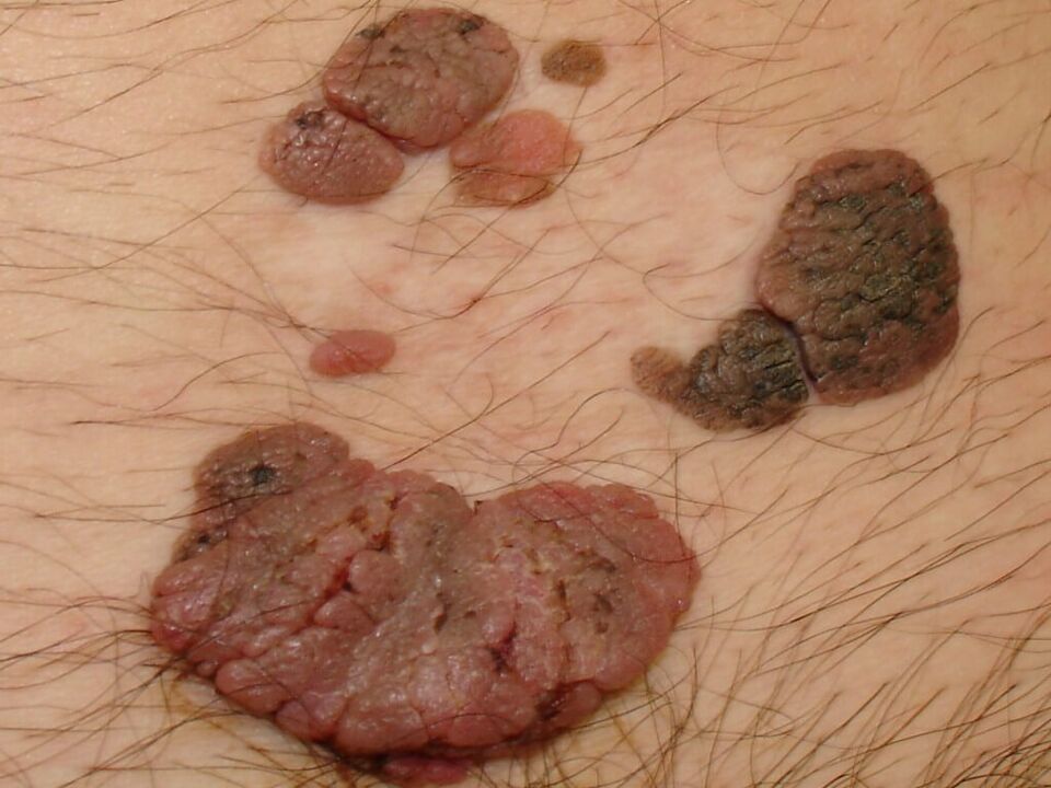 papilloma on the skin