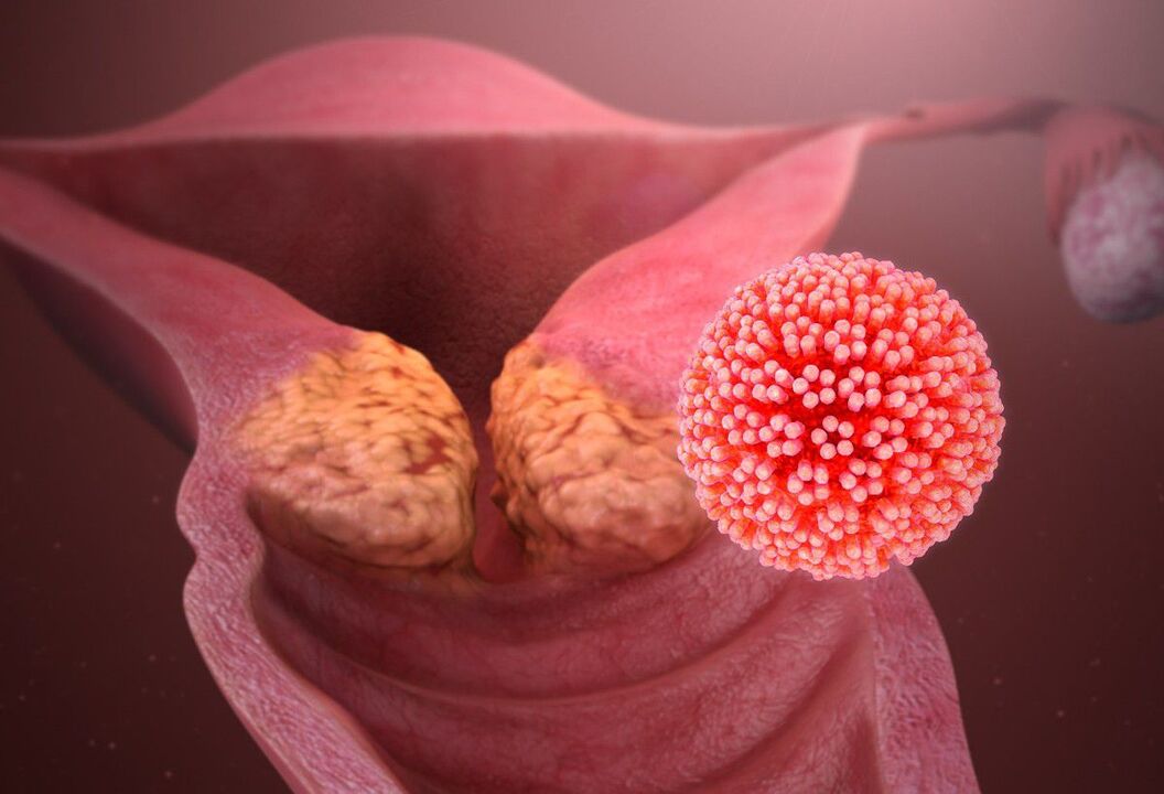 HPV lesions of the cervix
