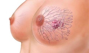 papilloma of the breast